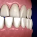 Teeth Underbite
