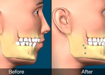 Corrective Jaw Surgery