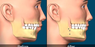 Corrective Jaw Surgery
