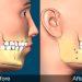 Corrective Jaw Surgery